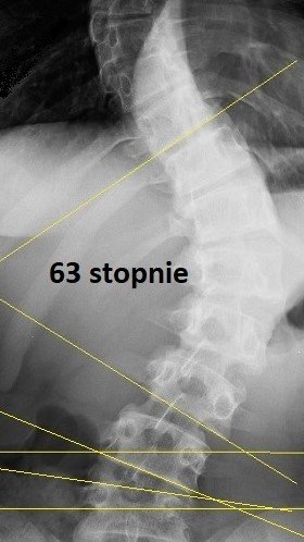 ok 63 stopni na początku, po 3 latach MRCST 40 stopni u Anny, lat 21