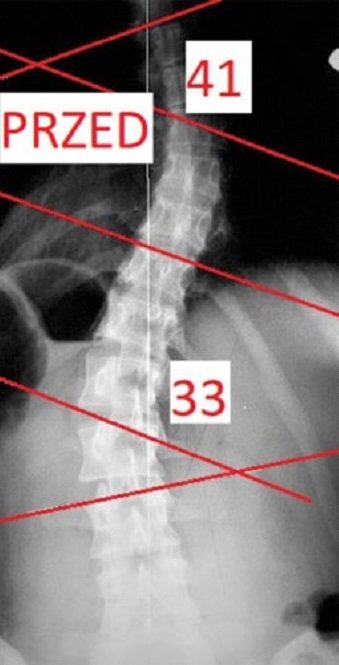 ok 41 i 33 stopnie na początku, po półtora roku MRCST 27 i 15 stopni u Katarzyny, lat 38