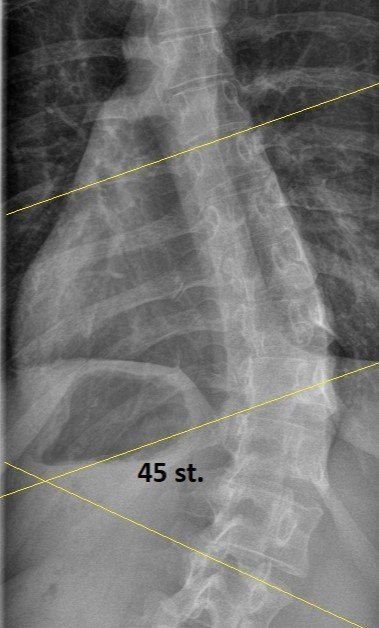 ok. 45 stopni na początku, po 7 miesiącach MRCST 32 stopnie u Sylwii, lat 30